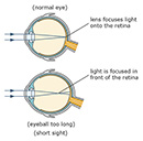 Thumbnail for eyeball short sight illustration