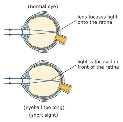 Illustration of short-sightedness